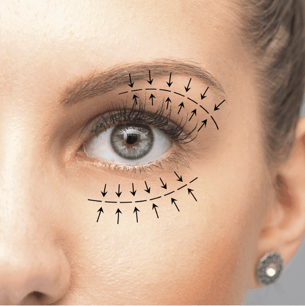 Blefaroplastia